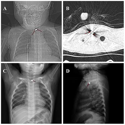 Simultaneous Esophageal and Tracheal Obstructions Caused by a Pair of Magnetic Beads in a Child: A Case Report